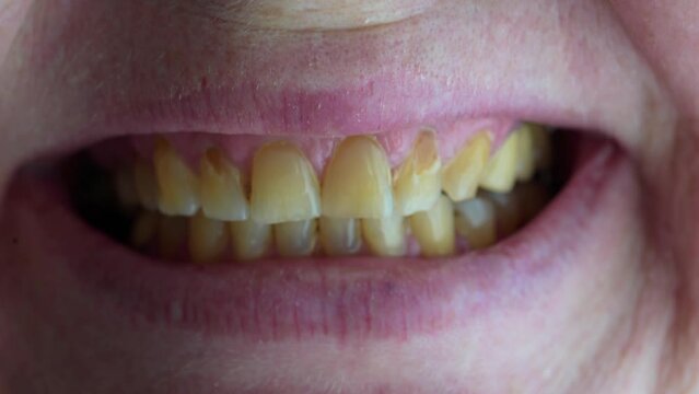 a woman smiles, lips and teeth with plaque and caries, woman's mouth macro