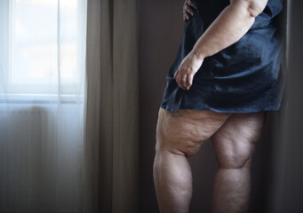 Fat woman with cellulite on her legs, cut out. - obrazy, fototapety, plakaty