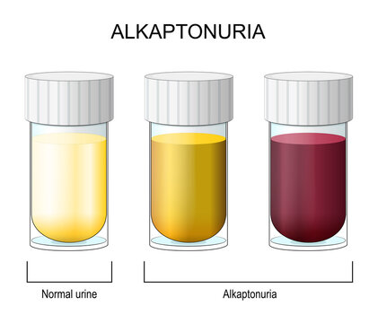 Alkaptonuria. Laboratory flasks with urine.