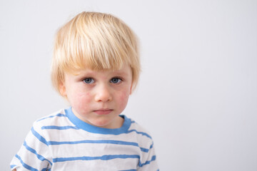 portrait of little boy with allergic rash or eczema on face. severe allergic reaction, atopic skin