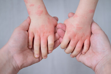 close up mother holding kids hands with allergic rash or eczema. severe allergic reaction, atopic...