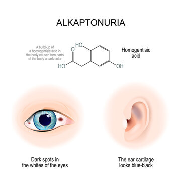 Alkaptonuria. sign and symptoms