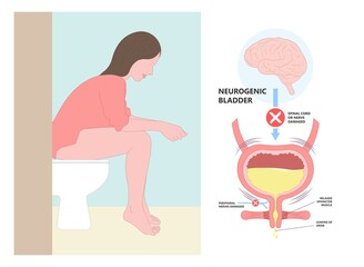 urge pass urine of pelvic floor muscle frequently Bed wetting toilet urination older nerve brain spasm tract tumor cancer stroke stress atonic Benign Lower Often leak anuria Neural Cystitis cord