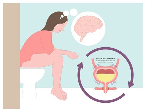 urge pass urine of pelvic floor muscle frequently Bed wetting toilet urination older nerve brain spasm tract tumor cancer stroke stress atonic Benign Lower Often leak anuria Neural Cystitis cord