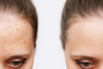 Cropped shot of a young woman's face before and after acne treatment on face. Pimples, red rash on...