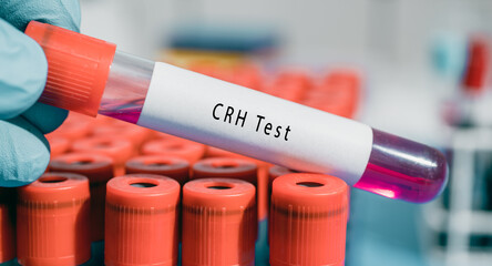 Hypothalamus Corticotropin releasing hormone  CRH Test  Regulates adrenocorticotropin release in...