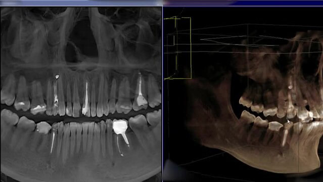 3D x-ray of jaw teeth. Fillings, a crown, sealed canals of the tooth are depicted. tomography