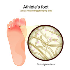 Athletes foot. Close-up of  Trichophyton rubrum