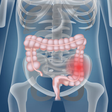 Bowel cancer. The location of the internal organs against the background of the skeleton. Abdominal cavity with disease indication