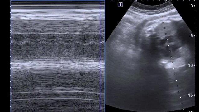 Ultrasound scan of the 30-week old babies' heartbeat
