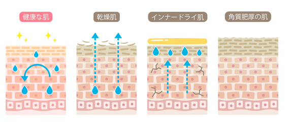 健康な肌とダメージ肌の断面図 