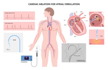 Cardiac catheter ablation treatment Atrial fibrillation rhythm problem minimally invasive procedure attack cath lab treat Coronary x-ray Radio frequency Sinus Ventricular SVT ECG ICD Radiofrequency AV