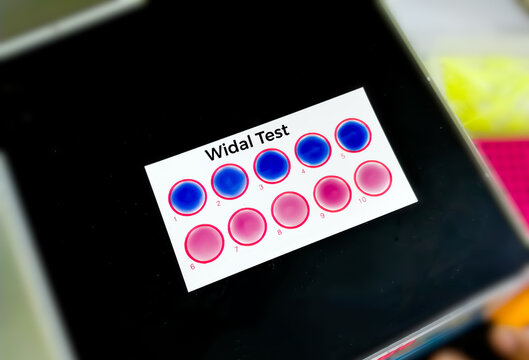 Widal test by agglutination method at plate isolated on black background. To diagnosis Typhoid and Paratyphoid fever at medical laboratory. Salmonella bacteria disease testing