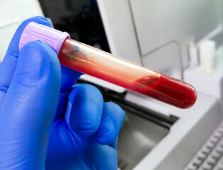 Hand holding blood sample in vacuum tube for hematological analysis.