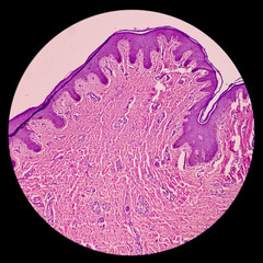 Infected wound tissue: Foreign body granuloma, skin, subepithelial tissue show granuloma, dense infiltration of polymorphs, lymphocyte, histiocytes and plasma cells.