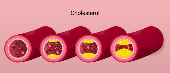 stage of cholesterol accumulation in blood vessels. Atherosclerosis. Clogged arteries caused by cholesterol.