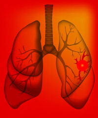 The illustration of sick human lungs with pain and sickness in a left lung. The picture is in the x-ray style. Can be used for medical, advertising and science materials. Vector illustration.