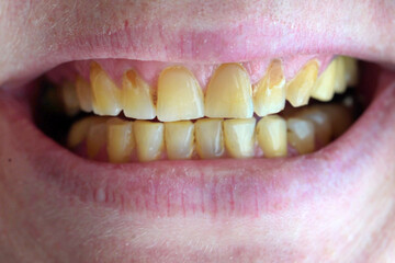 a woman smiles, lips and teeth with plaque and caries, woman's mouth