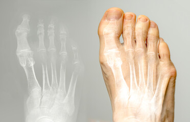 X-ray and the same foot. Hallux varus condition. - obrazy, fototapety, plakaty