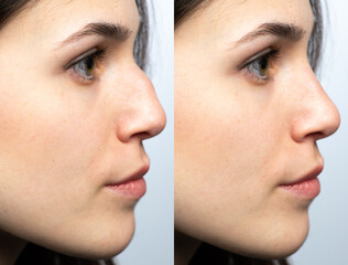 Nose before and after nasal filler surgery - obrazy, fototapety, plakaty