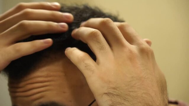 Young man controls hair loss. hair transplantation.