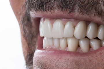 Obraz premium dental macro photography, ceramic crowns and veneers