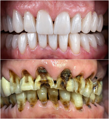 dental macro photography, ceramic crowns and veneers