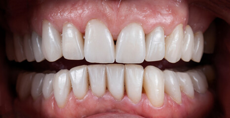 dental macro photography, ceramic crowns and veneers