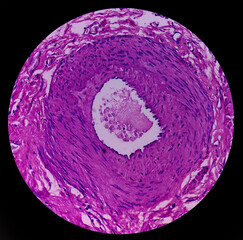 Fimbrial cyst(biopsy): show fallopian tube, features of fimbrial cyst, Acute abdomen, Paraovarian cyst, microscopic 40x view.