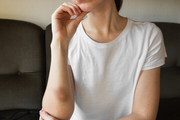 Young woman in white t-shirt with large bruise on arm. Victim of domestic violence.