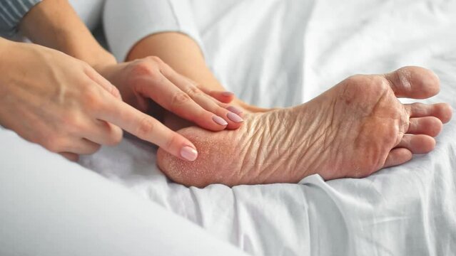 Close-up of a womans hands touching the dry rough cracked skin of her bare foot. Peeling, cracks and cornea sole of the feet. Dryness, dermatitis, dehydration, eczema, psoriasis concept.