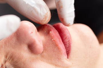 Young lady getting injections for bigger, fuller lips. The woman in the beauty salon. Plastic surgery clinic.
