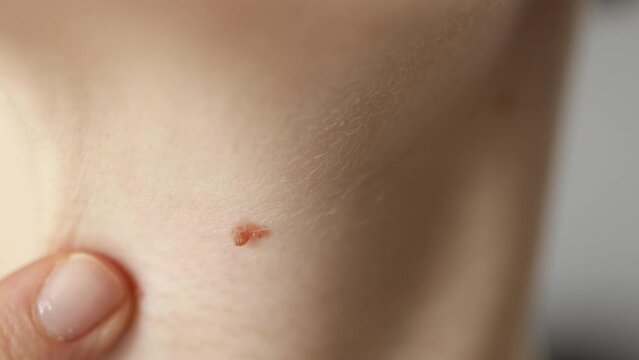 Examination brown mole nevus on caucasian skin. Melanoma selective focus.