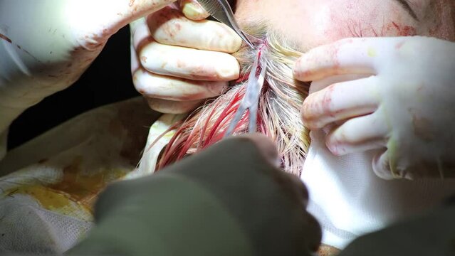 surgeon sews up the incision on the patient's head after brain surgery. Surgical traumatology.