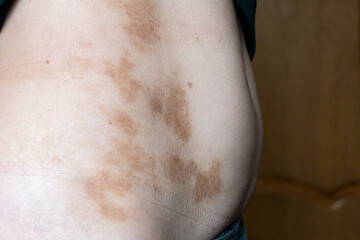 Large spots on the skin of a woman's body