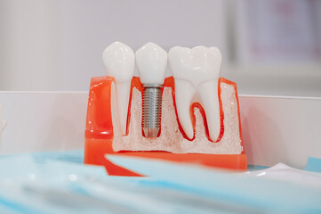 Close-up of dental mold on the table