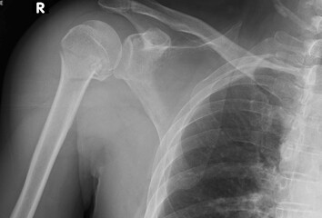 x-ray image of proximal  humerus  fracture