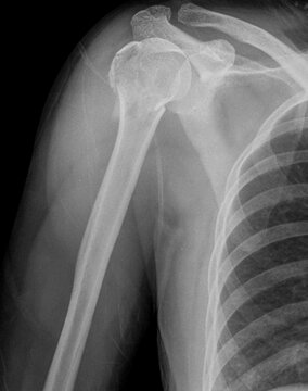x-ray image of proximal  humerus  fracture