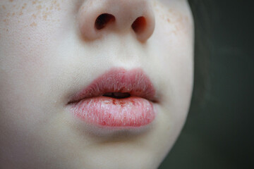 Dry and damaged lips of a girl. Close-up. Lip fissure and bleeding. Sick cracked damaged tissue. Dry lips with cracks, dry mouth, Closeup face with brittle and dry lips, dehydration High quality photo