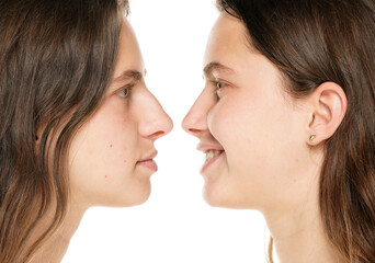 Young smiling woman before and after plastic surgery of the nose on a white background