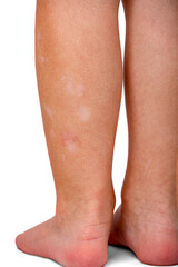 traces of atopic dermatitis on children's feet