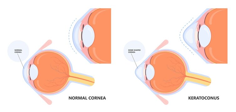 eye vision blurry retina atopy Keratoconus dry shape loss double cloudy myopia lasik glare exam vernal	