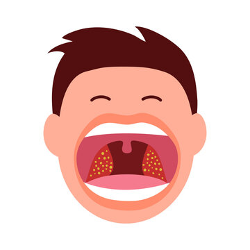 Man open mouth with tonsils throat infection in flat design on white background.