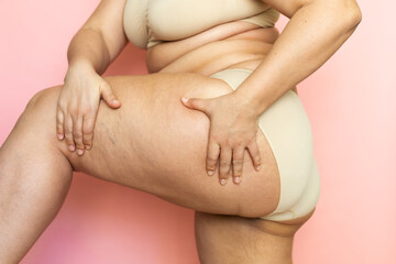 Cropped image of overweight woman sag hips, buttocks, with obesity, excess fat in lingerie....