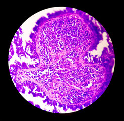 Endometrial (Uterine) cancer awareness: Photomicrograph of uterine biopsy showing Endometrial...