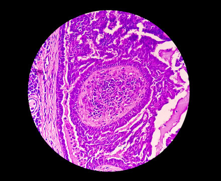 Endometrial (Uterine) Cancer Awareness: Photomicrograph Of Uterine Biopsy Showing Endometrial Cancer Or Endometrial Carcinoma.