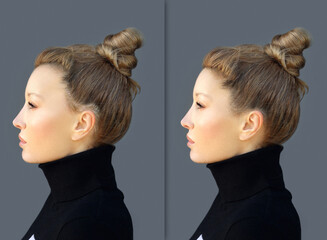 Alopecia Areata,female pattern baldness,Treatment for hair loss,Hair transplant,Surgery to implant...