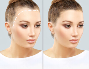 Alopecia Areata,female pattern baldness,Treatment for hair loss,Hair transplant,Surgery to implant...