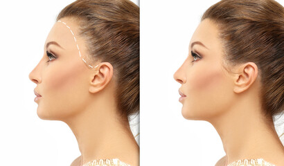 Alopecia Areata,female pattern baldness,Treatment for hair loss,Hair transplant,Surgery to implant artificial hairs