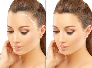 Alopecia Areata,female pattern baldness,Treatment for hair loss,Hair transplant,Surgery to implant...